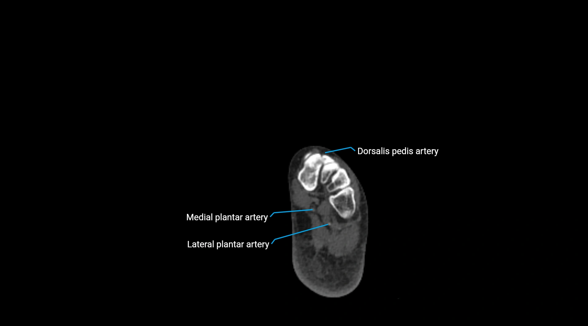 CTA lower limb cross sectional anatomy labelled image _289.webp